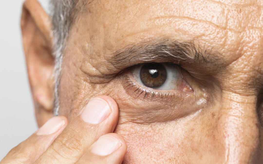 Glaucoma: entenda a doença